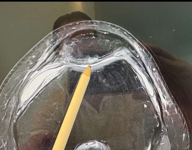 Dr. Böttenberg klärt auf: Microfracture am Knie bei schweren Knorpelschäden (CM 4°)